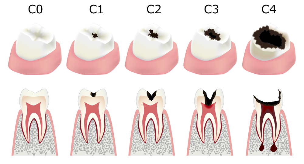 虫歯になる理由、その治療法