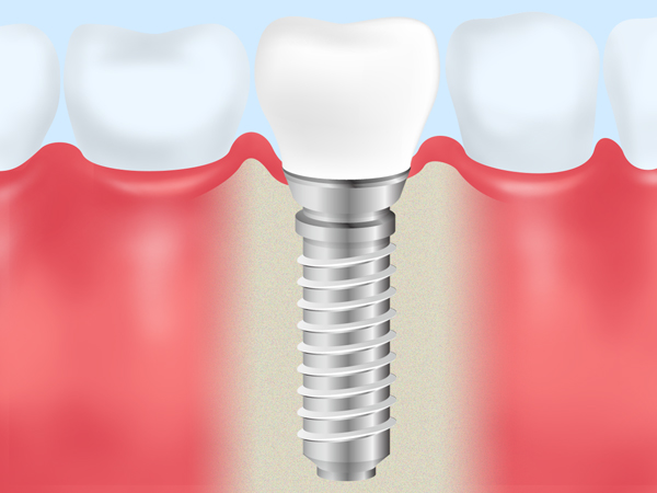 当院のインプラント治療について