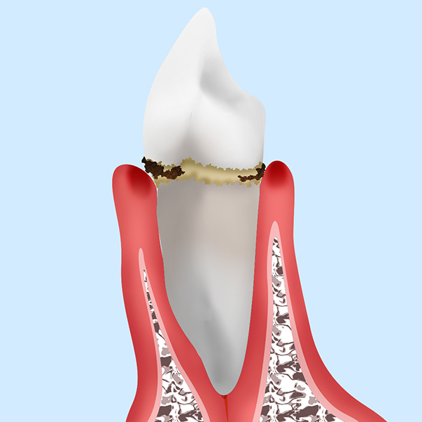 軽度歯周病（歯肉炎）
